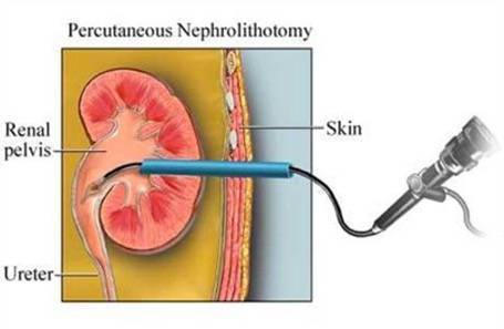 confounding-percutaneous-nephrolithotomy.jpg